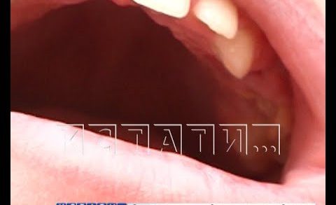 Зубной конфуз — врач по ошибке удалила вместо расколовшегося молочного зуба — соседний, постоянный