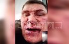 Чемпион России по пауэрлифтингу получил удар ножом от постояльца, но переломал ему ноги