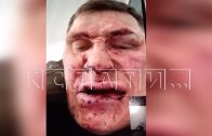 Чемпион России по пауэрлифтингу получил удар ножом от постояльца, но переломал ему ноги