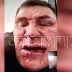 Чемпион России по пауэрлифтингу получил удар ножом от постояльца, но переломал ему ноги