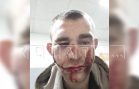 Пьяного мужчину, которого тёща сдала в полицию, чтобы проспался, избили до переломов костей лица