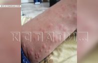 Черви церкарии нападают в воде на купающихся в озёрах Нижнего Новгорода
