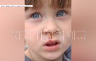 Охотничья собака напала на 3-летнюю девочку и изуродовала лицо