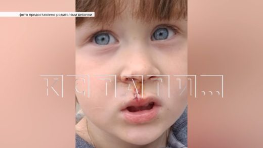 Охотничья собака напала на 3-летнюю девочку и изуродовала лицо