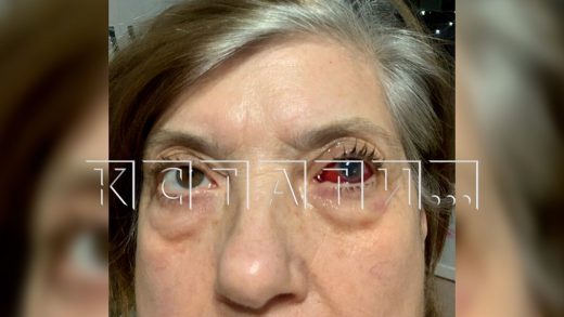 Отец покрывал дочь, которая делала операции, говорив по сотовому, и лишила пациентов зрения и денег